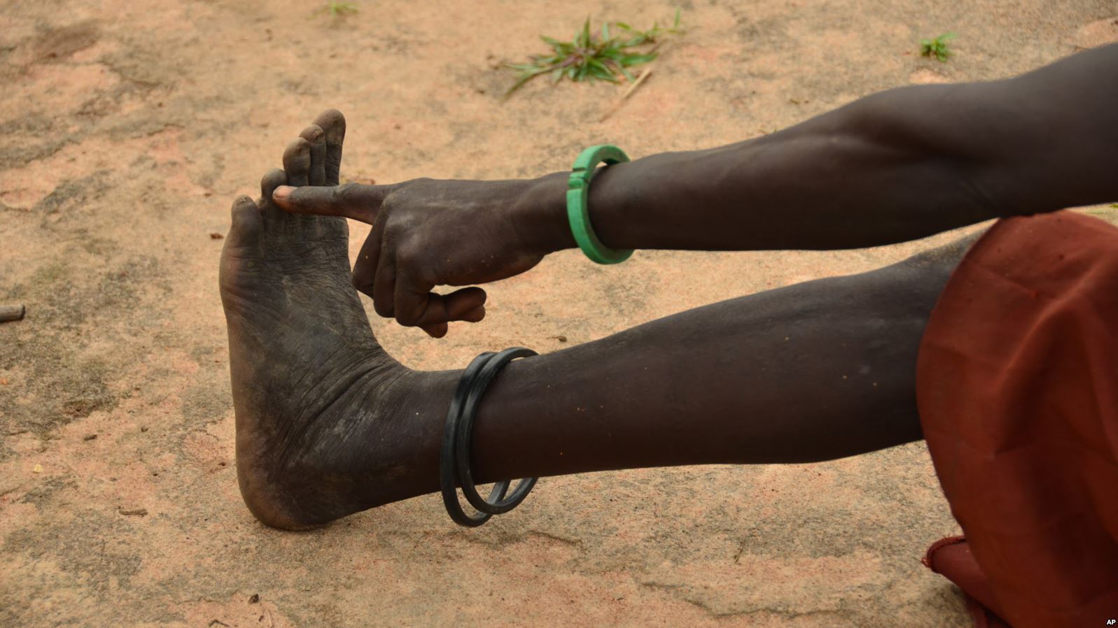 Sudan Selatan Tumpas Penyakit Cacing Guinea